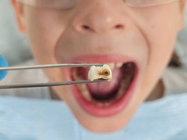 Best Same-Day Emergency Dental Services in Osburn, ID